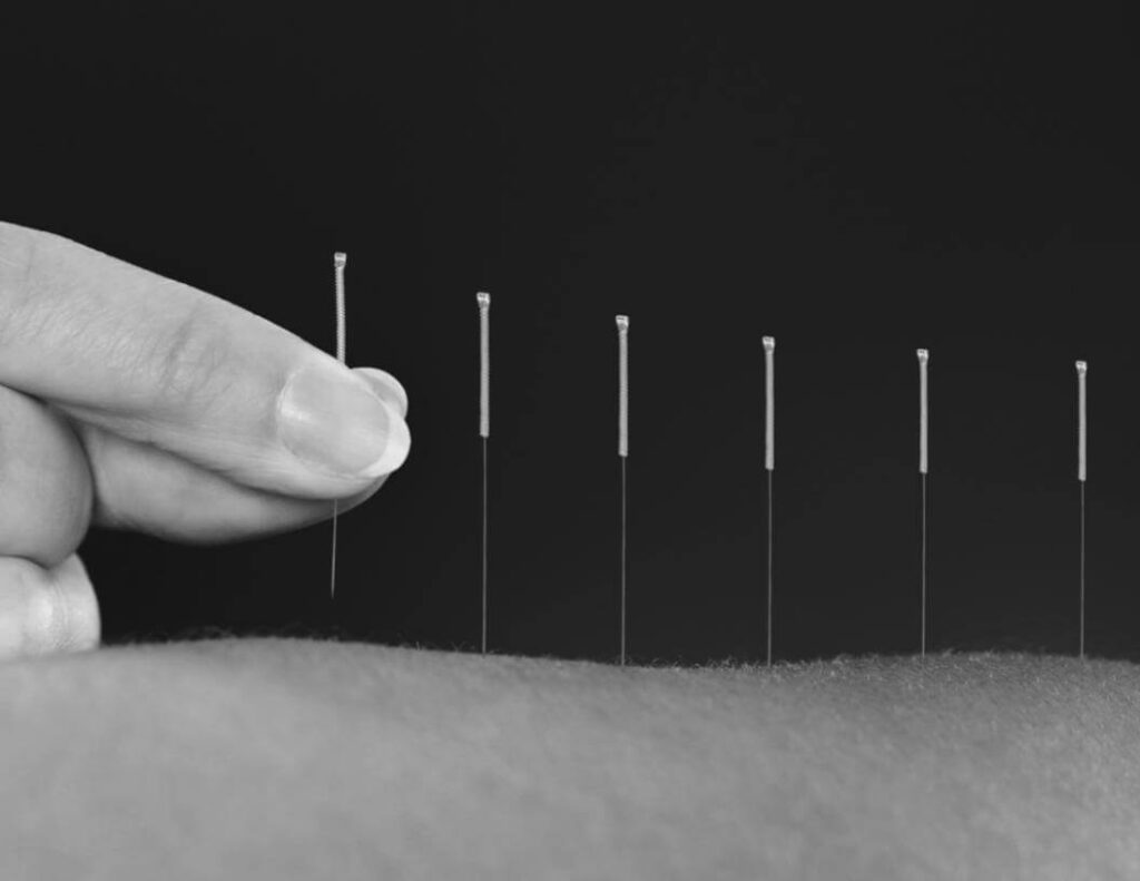 Acupuncture and Its Benefits