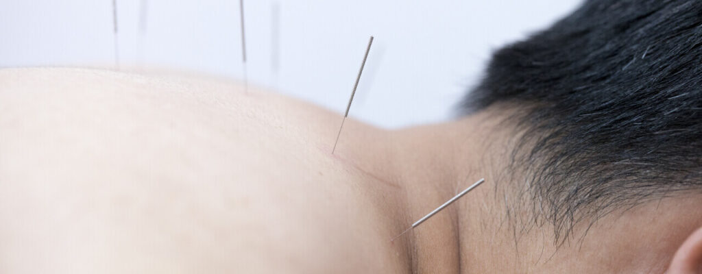 Find Effective Relief for Your Pain with Acupuncture