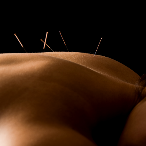 Dry-needling-ProClinix-Sports-Physical-Therapy-and-Chiropractic-Armok-Pleasantville-Ardsley-West-Harrison-Tarrytown-Larchmont-NY