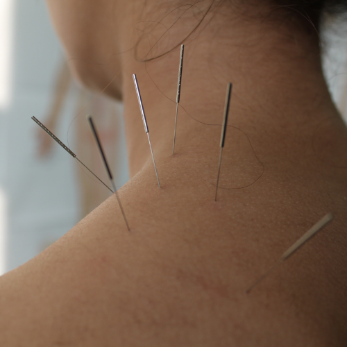 acupuncture-ProClinix-Sports-Physical-Therapy-and-Chiropractic-Armok-Pleasantville-Ardsley-West-Harrison-Tarrytown-Larchmont-NY