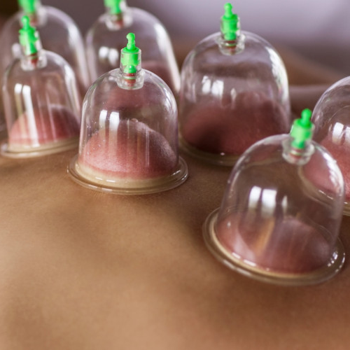 cupping-therapy-ProClinix-Sports-Physical-Therapy-and-Chiropractic-Armok-Pleasantville-Ardsley-West-Harrison-Tarrytown-Larchmont-NY
