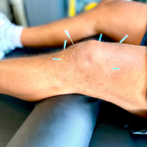 Knee Dry Needling