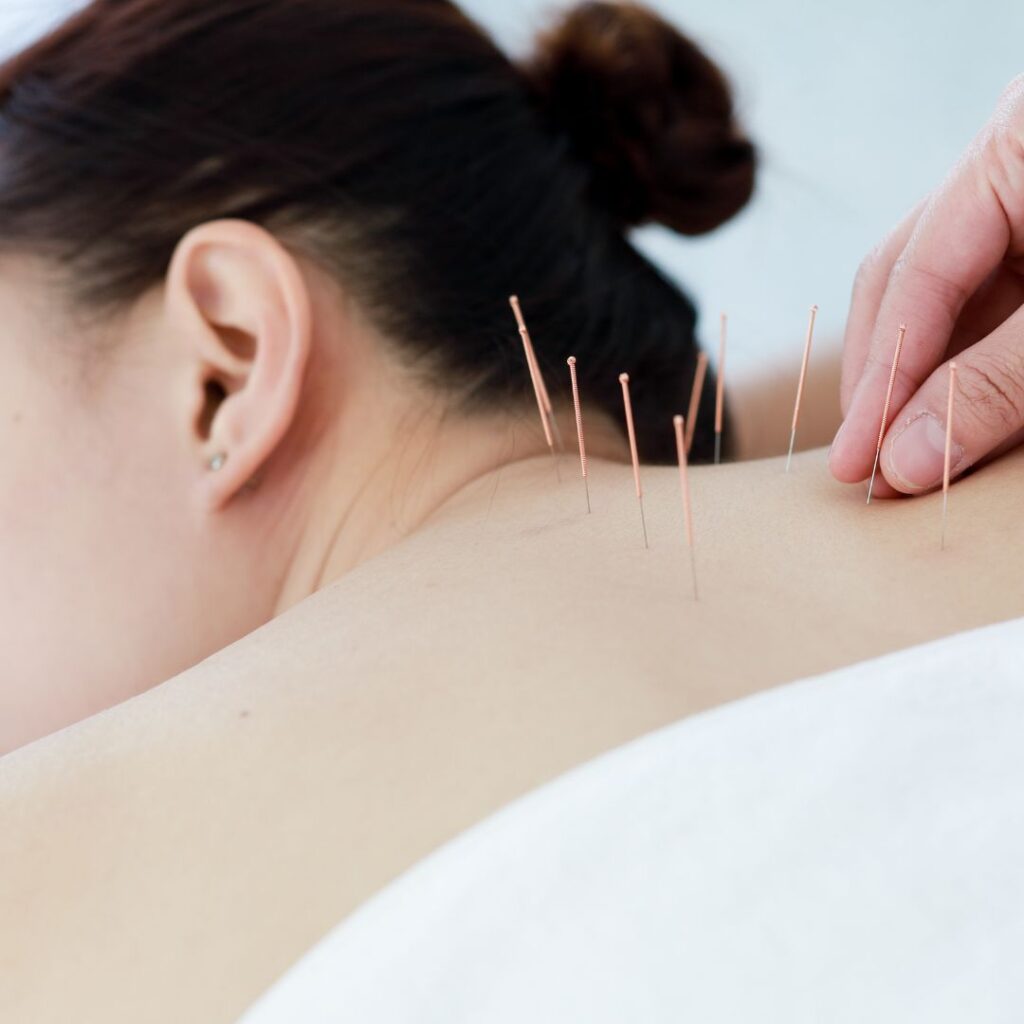 Acupuncture and Menopause: Supporting the Body Through Transition